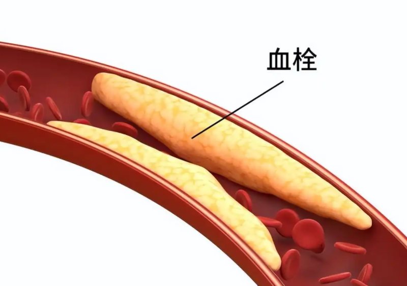  别再盯着嘴唇了：脑梗预防的逆向思维与真相 健康养生